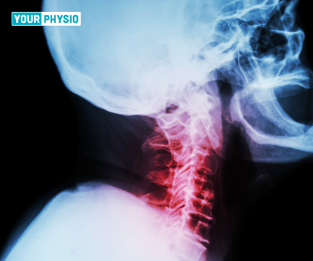 Cervical Spondylosis: Exercises to Do & Movements to Avoid