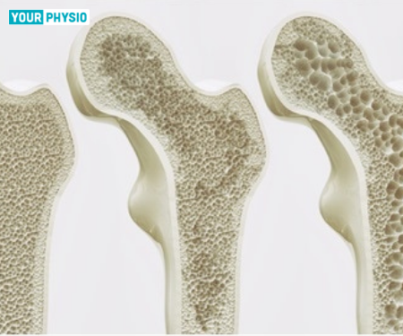 The Ultimate Guide To Learn About Osteoporosis: Symptoms, Prevention & FAQs