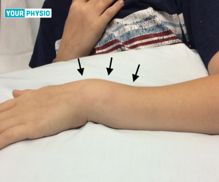 Colles Fracture: Types, Symptoms & Physiotherapy Management
